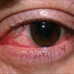 कञ्चनपुरमा वायु प्रदूषणका कारणले  आखाका बिरामी बढे !