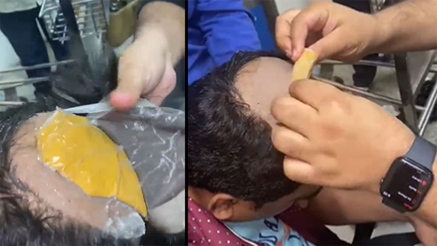 मलद्वार र तालुमा भेटियो आधा किलो सुन !